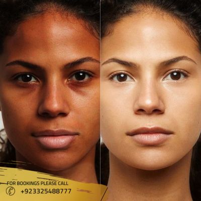 Best Skin Whitening Injection in Islamabad, Pakistan