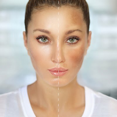 Melasma Treatment in Islamabad Pakistan - RCS