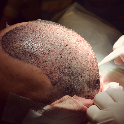 Best FUE Hair Transplant in Islamabad, Pakistan