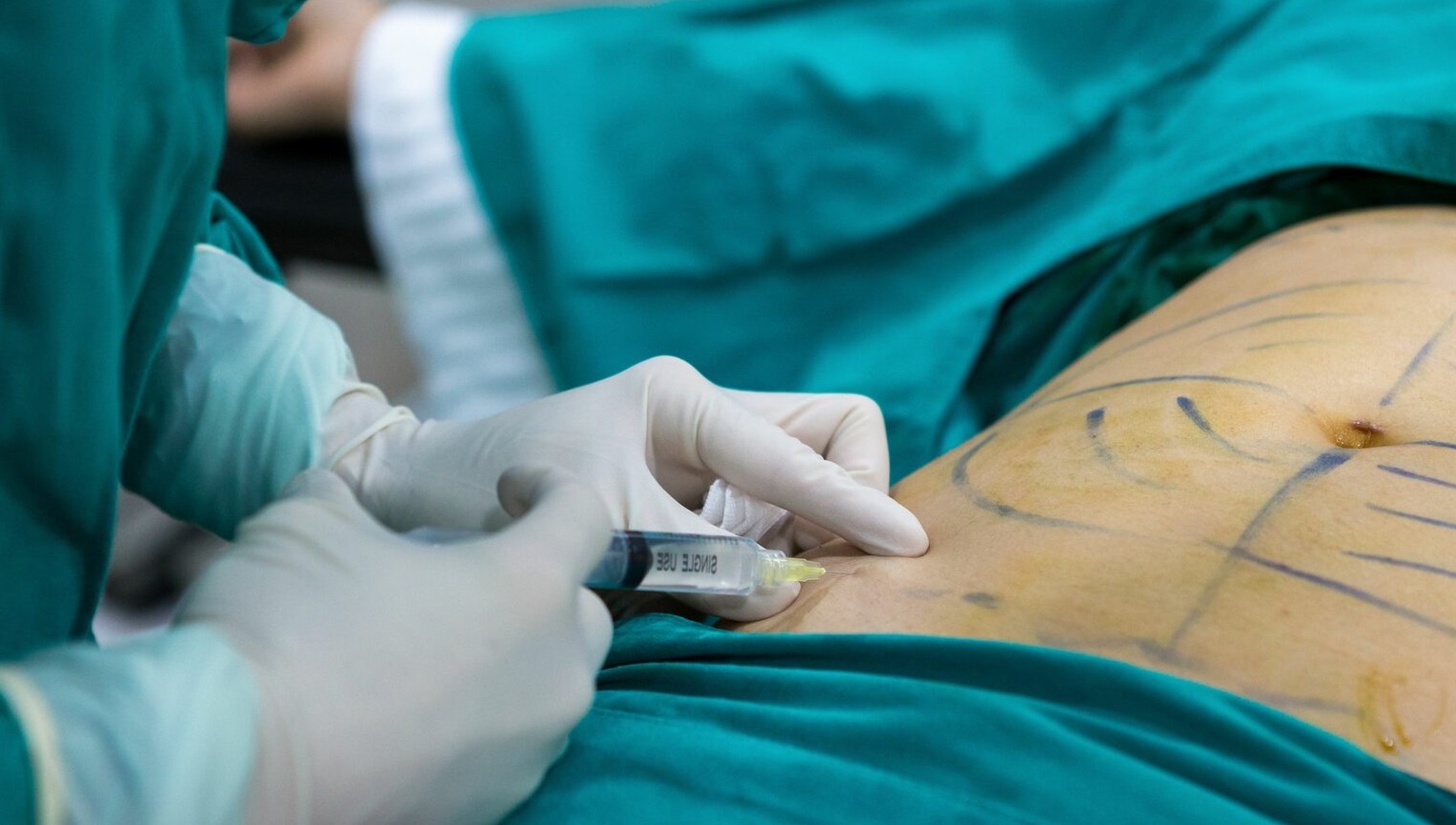 Best Liposuction Clinic in Islamabad