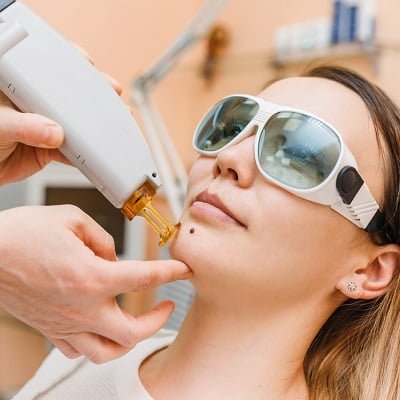 Mole Removal in Islamabad, Rawalpindi, and Pakistan