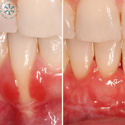 Best Periodontist for Gum Grafting in Islamabad