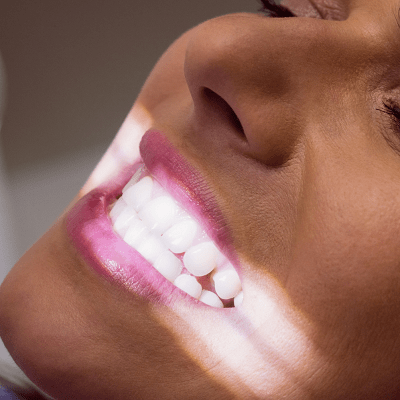 Best Laser Teeth Whitening in Islamabad
