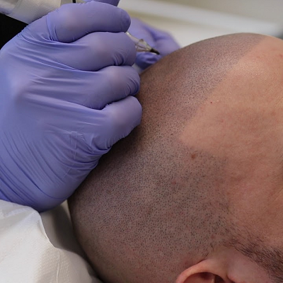 Best Scalp Micropigmentation in Islamabad, Pakistan